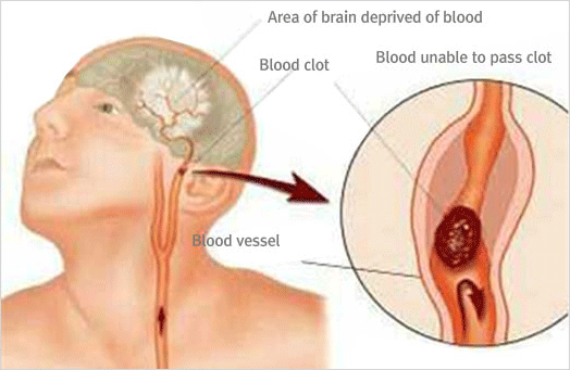 두상왼쪽 귀 앞 혈관이 막히면서 발생하는 뇌혈관질환을 예시 사진